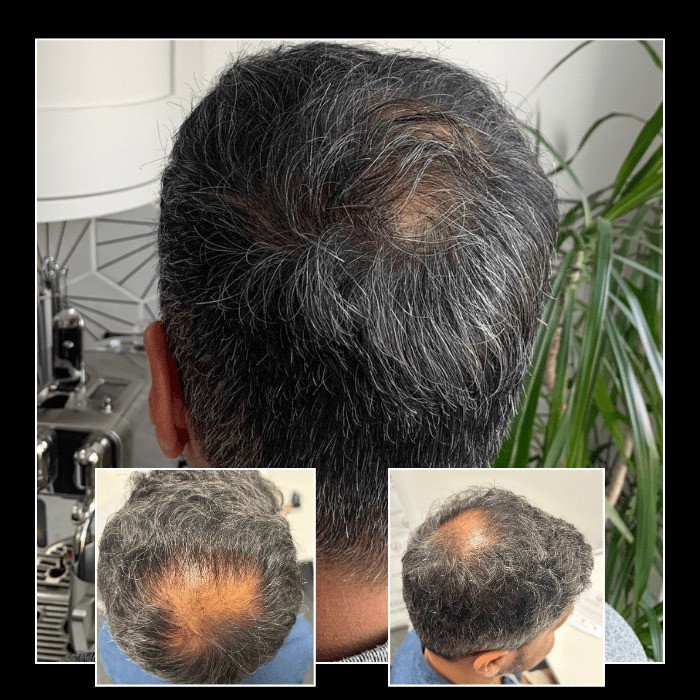 imageye____imgi_65_beforeafterhairtransplantharleystreetlondon01.jpeg