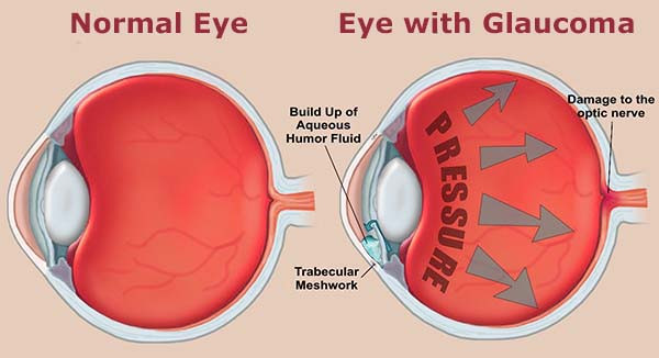 glaucoma.jpg