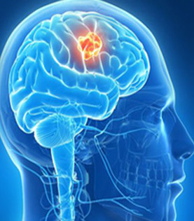 Brain surgery in Bangalore: The bottom line