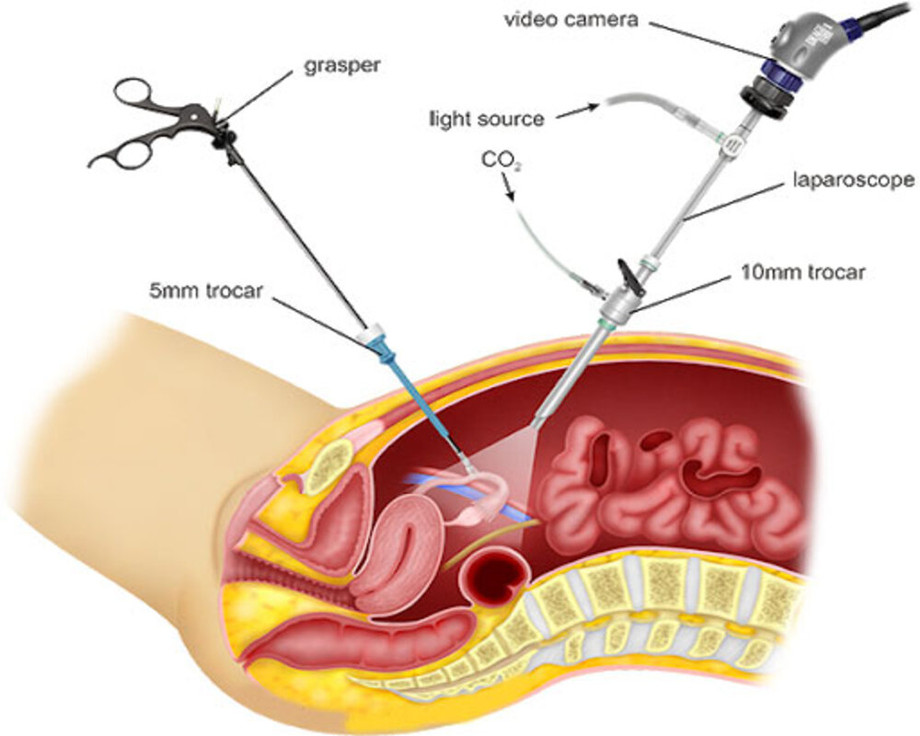 totallaparoscopichysterectomy1.jpg