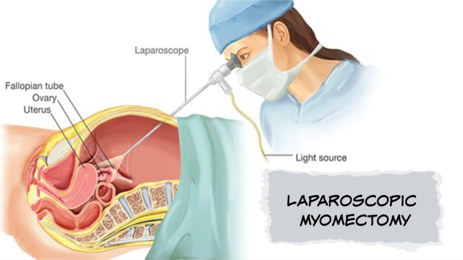 laparoscopicmyomectomy3.jpg