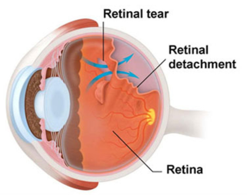 retina.jpg