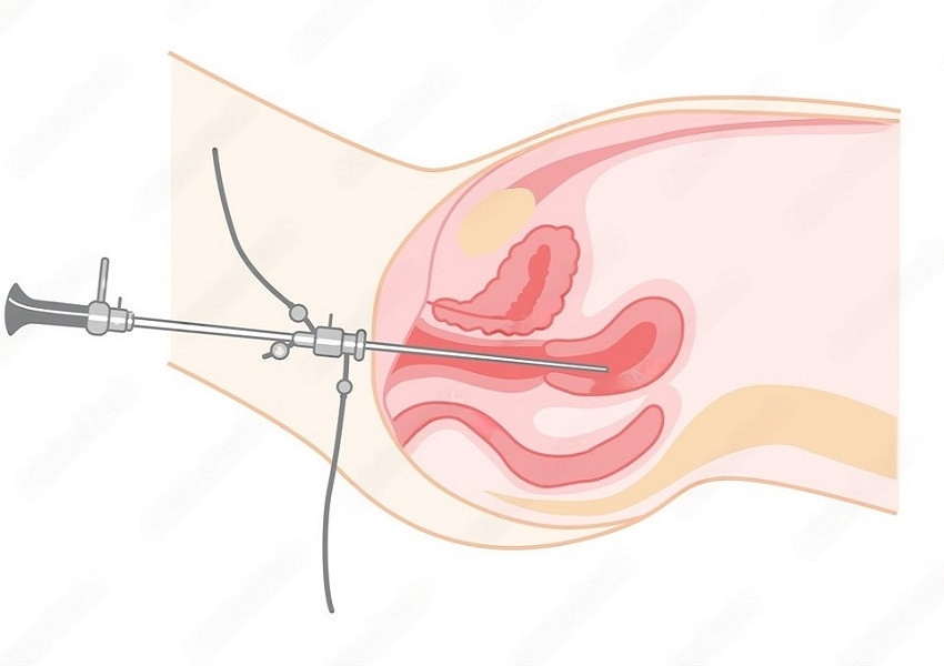 hysteroscopy.jpeg