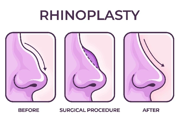 rhinoplastysurgery.webp