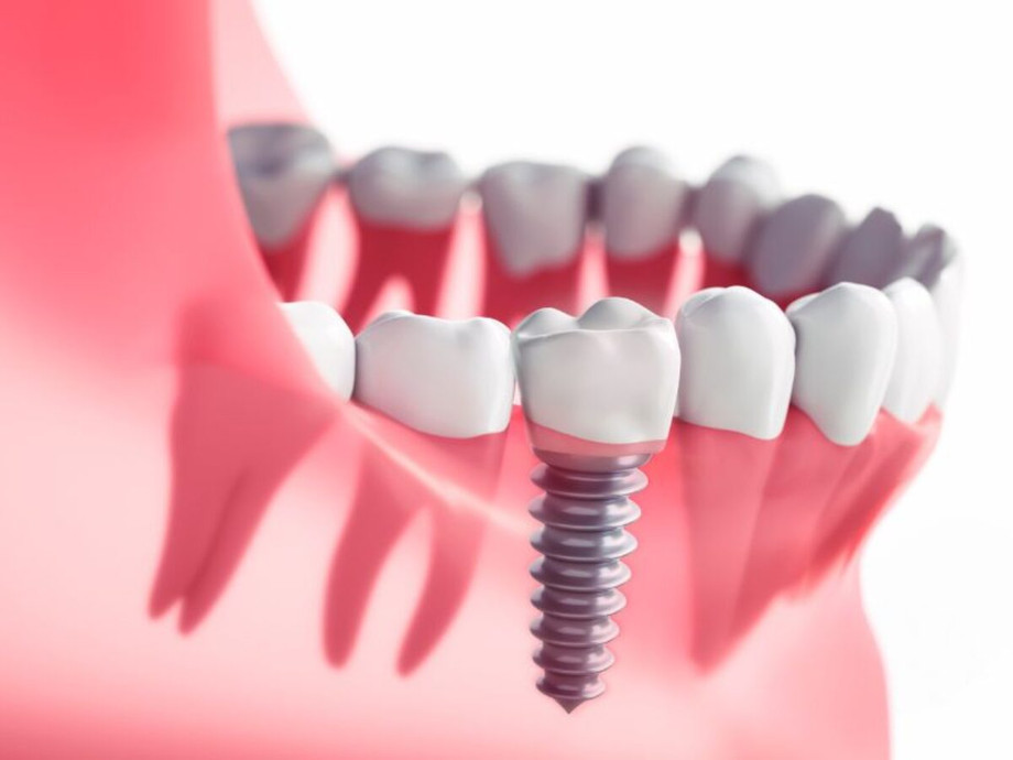 dentalimplantsolutions.jpg