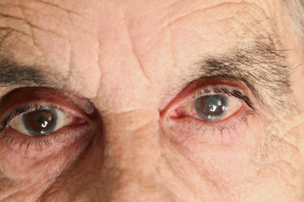 glaucoma.png