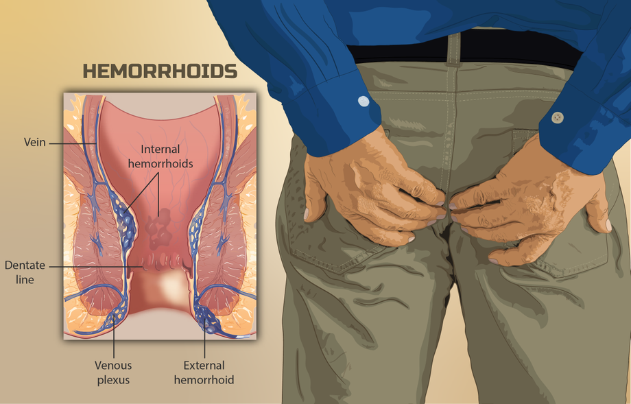 hemorrhoids.png