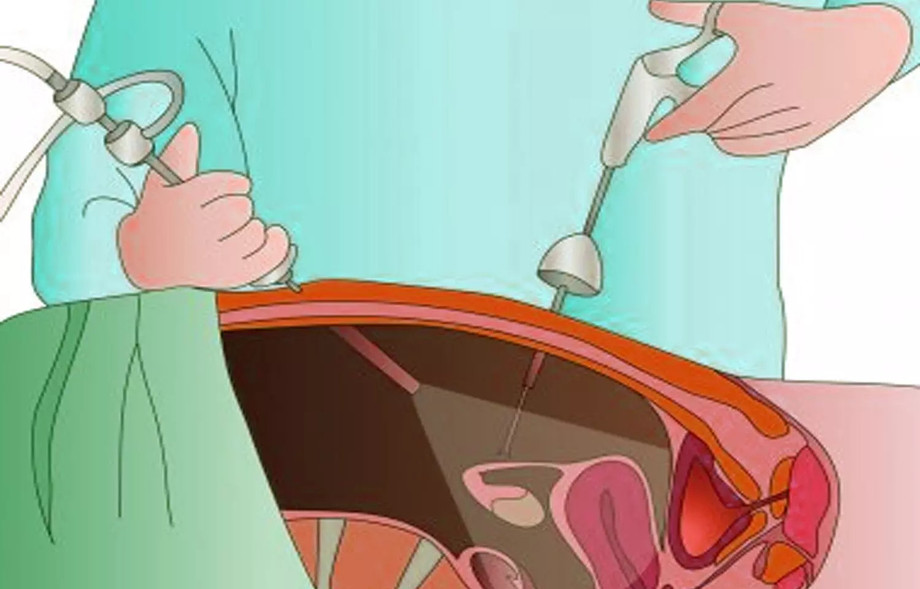 laparoscopichysterectomy1.jpg