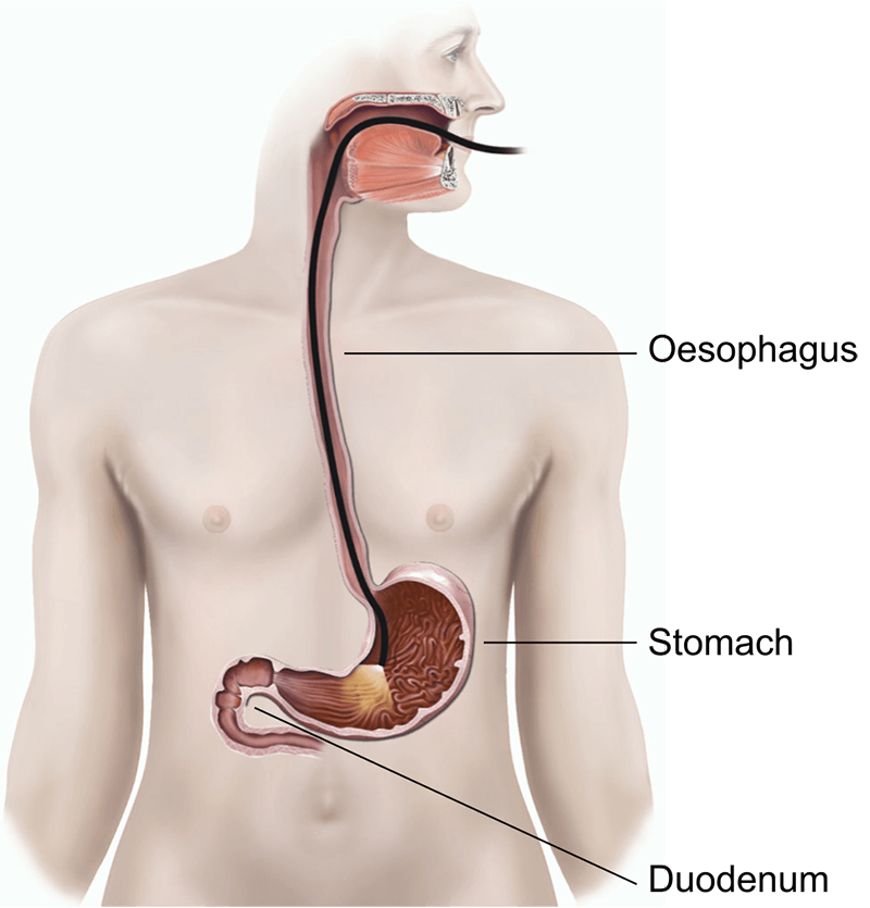 uppergiendoscopycolonoscopyillustration3fc660.png