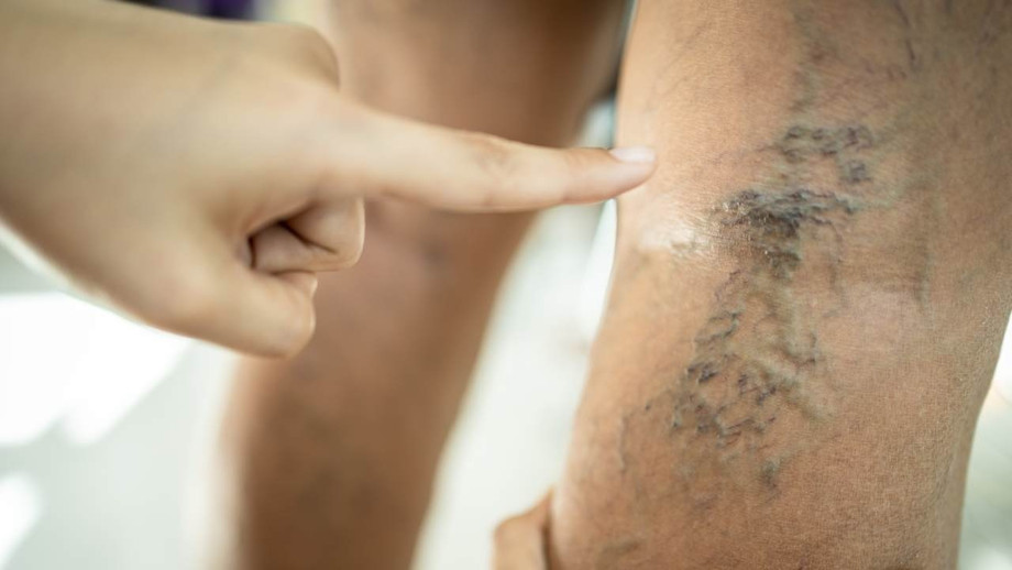 veintreatmentclinicspider.jpg