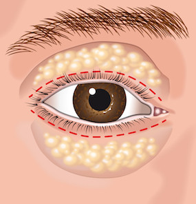 blepharoplastyintraop1.jpg