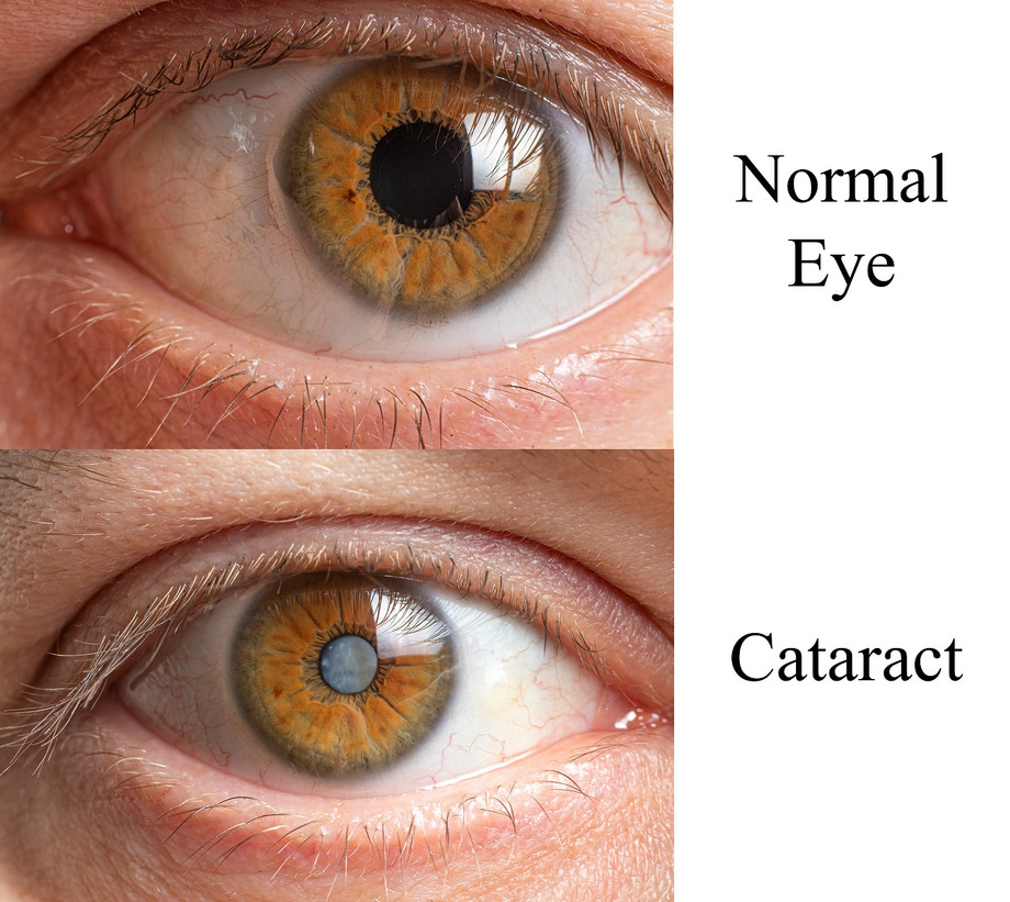 normaleyevscataract.jpg