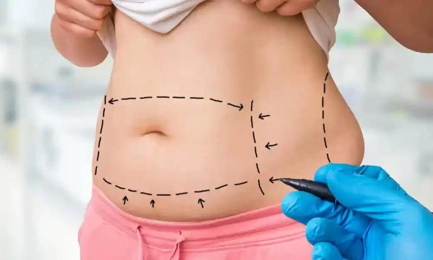 minitummytuckrecovery860x516.jpg