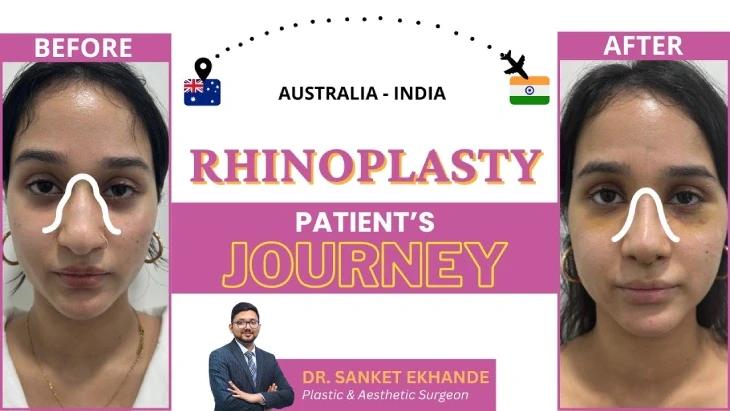 rhinoplastypatientfromaustralia.webp