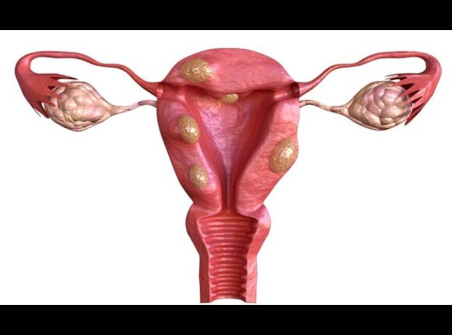 uterinefibroidremoval1.jpg