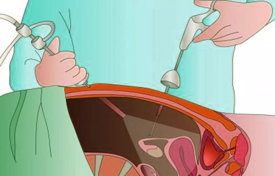 fibroid.jpg