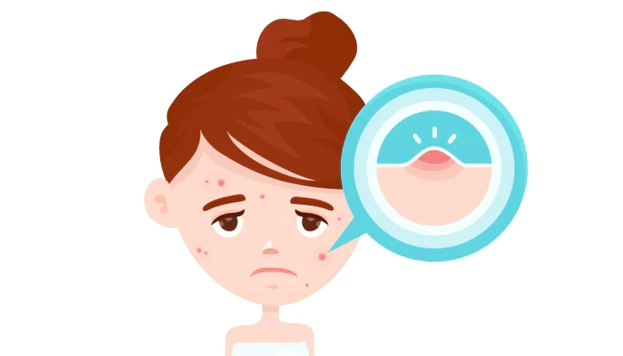 acne_1024x1024.webp
