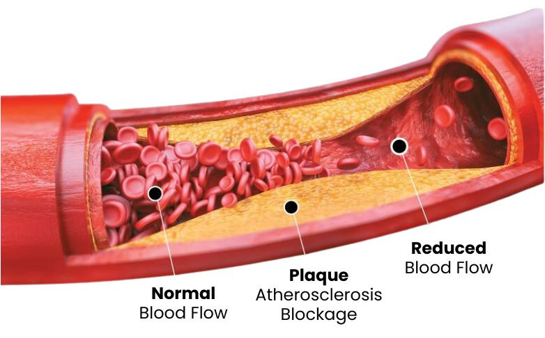 causesofperipheralarterialdisease.jpg