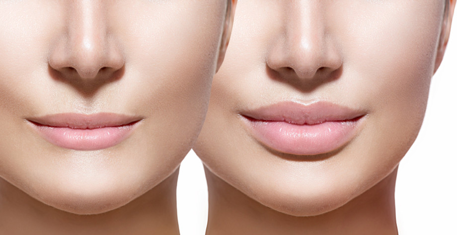 beforeandafterlipfillers.jpeg