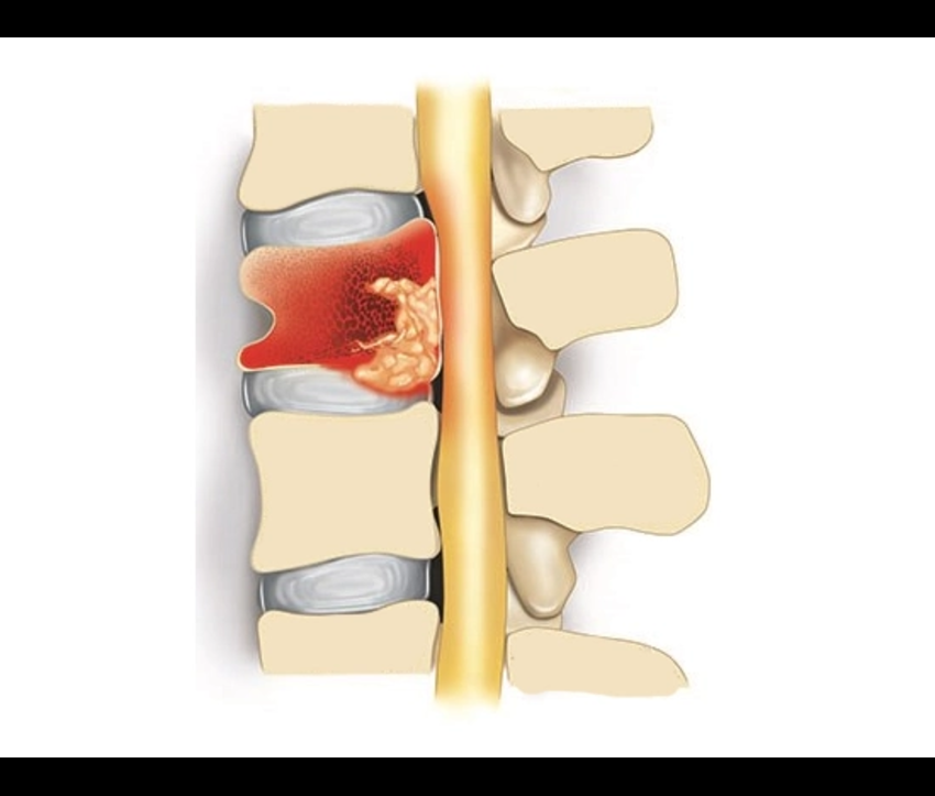 spineinfections.png