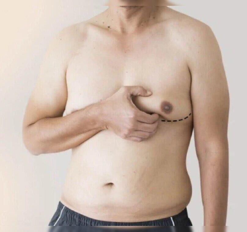 gynecomastiasanket.jpg