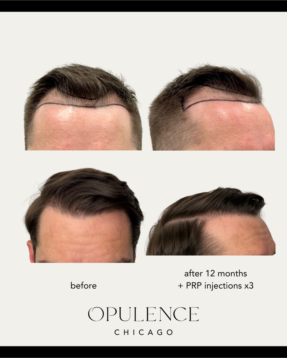 fuehairrestorationbeforeandafter1yearopulencechicago.png