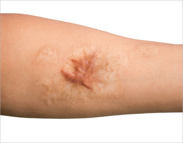 keloidhypertrophicscars.jpg