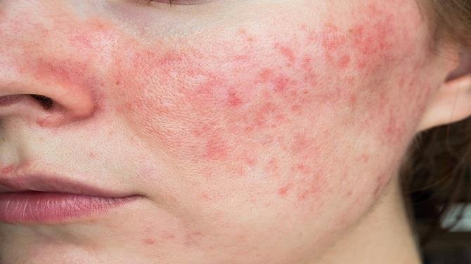 rosacea3.jpg