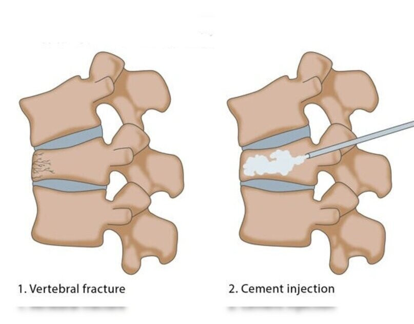 vertebroplastysynapsespine.jpg