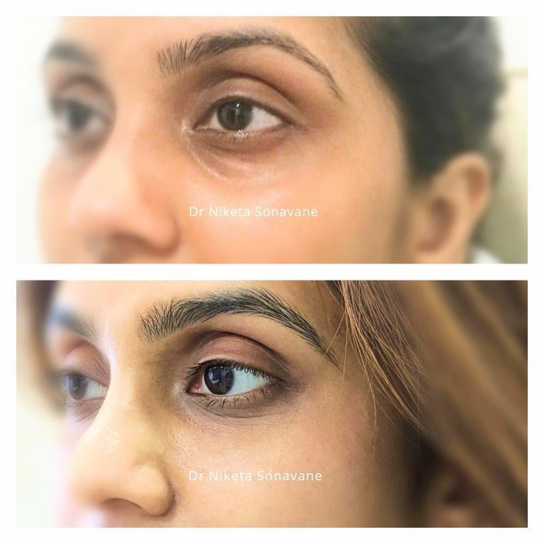 darkcirclestreatmentinmumbaiundereyefillersinmumbaidermalfillersinmumbaibeforeafter2768x768.jpg
