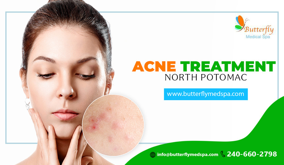 acnetreatmentnorthpotomac.jpg
