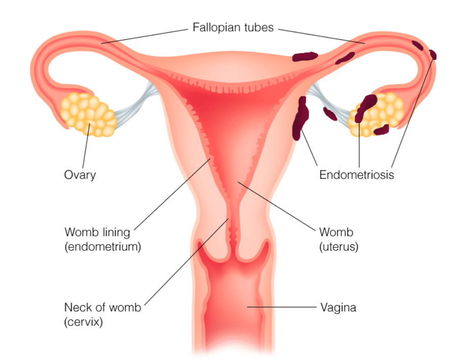 endometriosisconceptnutrition.png