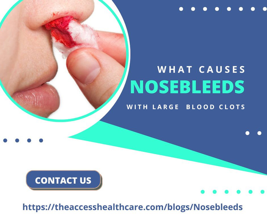 whatcausesnosebleedswithlargebloodclots.jpg