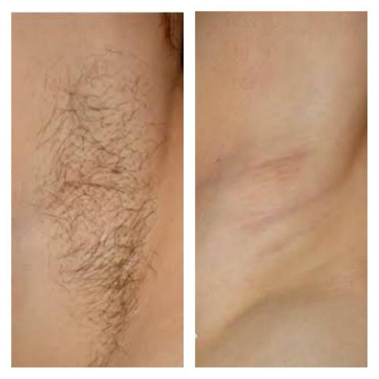 laserhairremovalinmumbaibeforeafter768x768.jpg