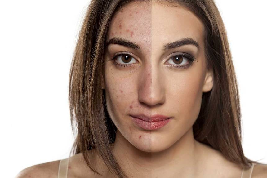 acnescartreatment.jpg