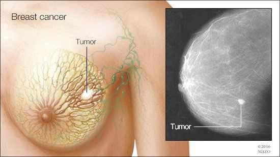 breastcancer.jpeg