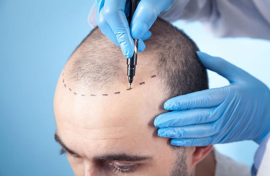 howtodeterminehairlosssurgerycostinindia.jpg