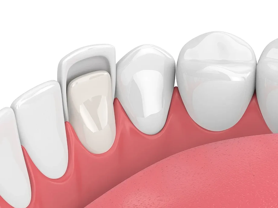 imgi_16_649ac59cfe86a6d0388b10a5_servicethumbnailveneers.webp