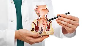 hemorrhoids1.jpg