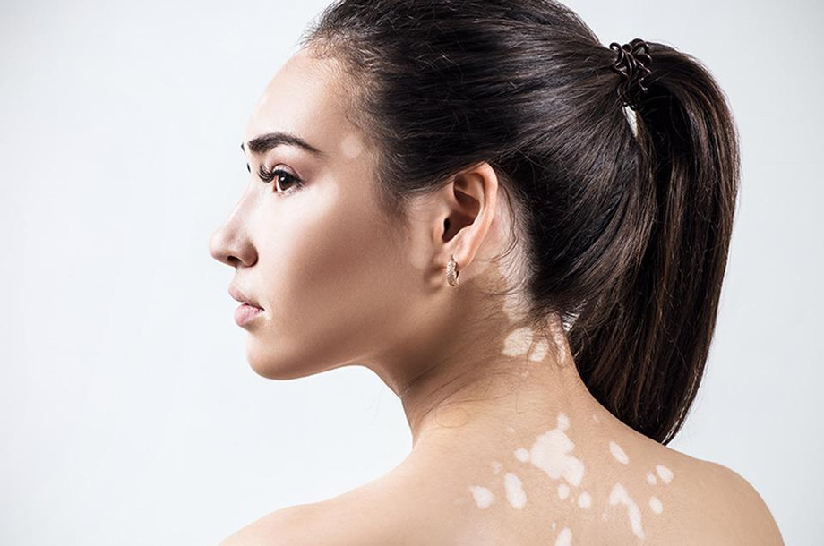 treat_vitiligo_with_ayurveda__d.jpg