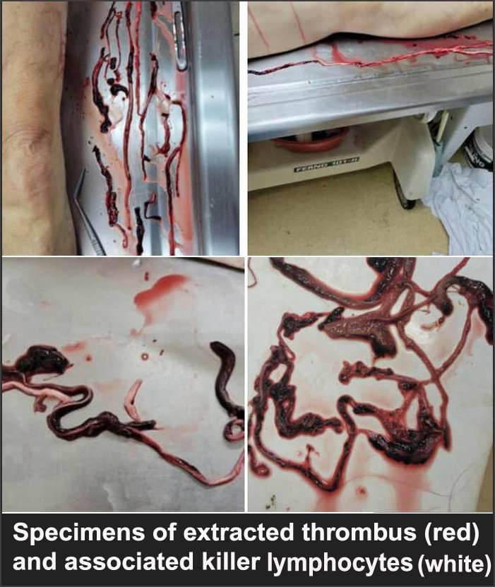 thrombusandkillerlymphocyteslideb.jpg