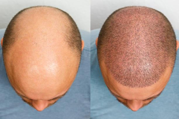 hairtranplanttoronto.jpg