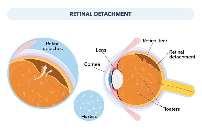 retinaldetachmentblindness678x446.jpg