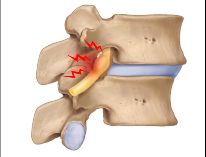 spondylolisthesis.png