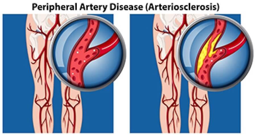 peripheralarterialdisease.jpg