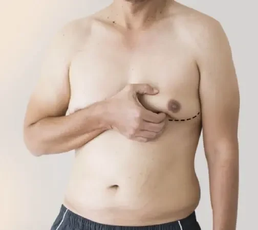 gynecomastia.webp