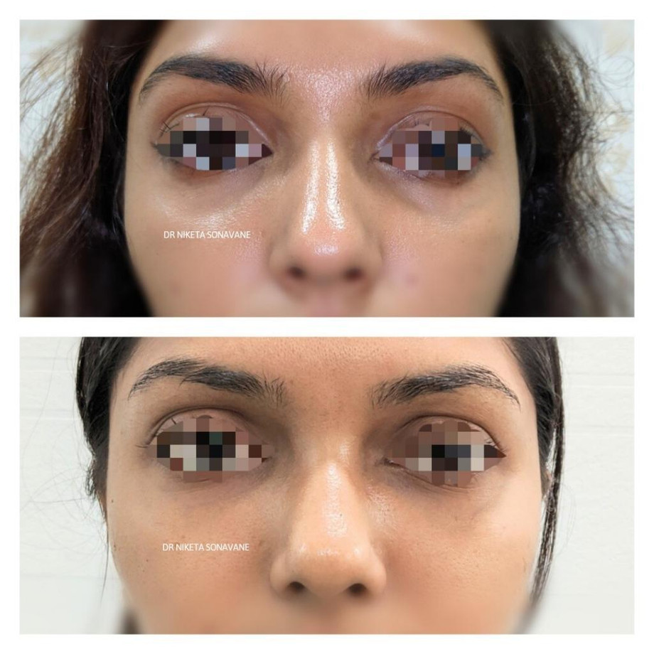 undereyefillersinmumbaibeforeafterresultsdarkcirclestreatmentinmumbaidermalfillersfordarkcirclesinmumbai1024x1024.jpg
