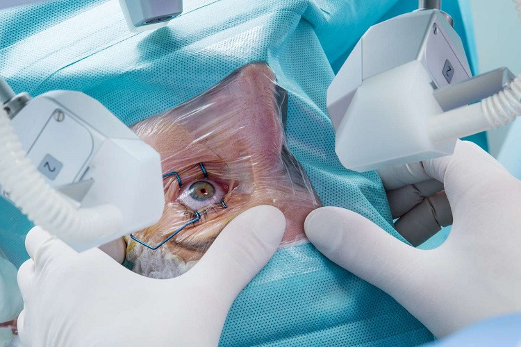 getthebestlasercataractsurgeryforyoureye.jpg