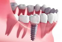 implant dentures