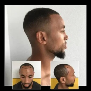 imageye____imgi_30_beforeafterhairtransplantbrentwoodessex081300x300.jpeg